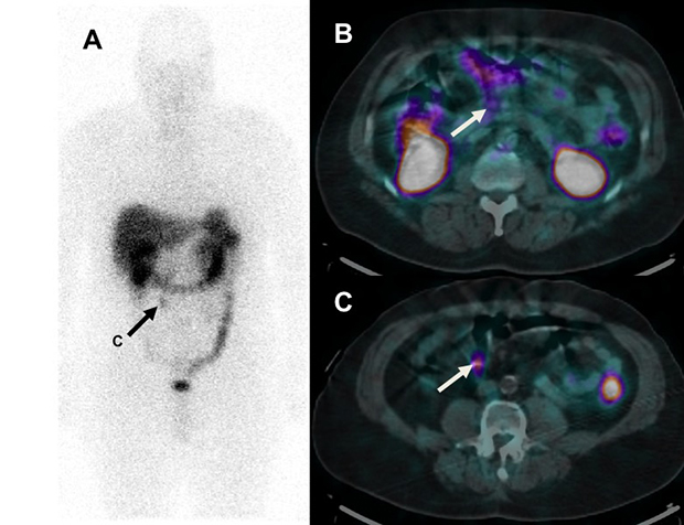 Leveraging Datature Nexus for Tumor and Anomaly Detection in Medical Scans  : Part I