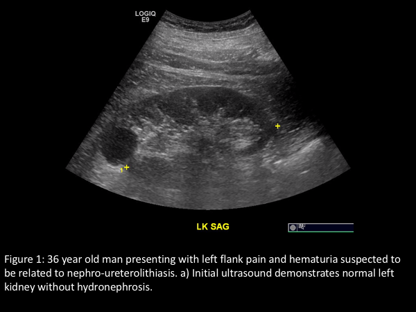 Differential Diagnosis of Flank Pain, PDF, Kidney