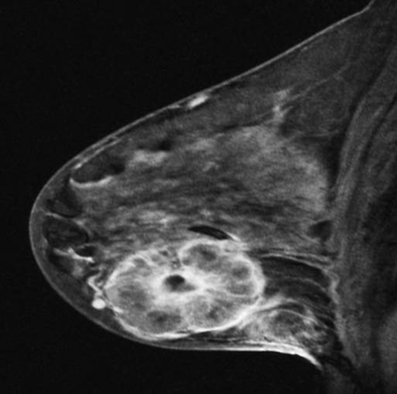 The lactating breast mri findings and literature review