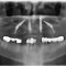 An X-ray showing the position of “All-on-4” maxillary implants.