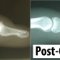 “The above radiographs depict a before and after total DIP joint replacement procedure.  Patient suffered from osteoarthritis as shown by the bone spurs pictured on the left.  After surgery, patient reported full range of motion and relief of pain in the finger.” Photos provided by David Elliot.