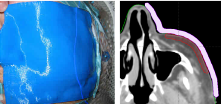 Dosimetrist/Physicist Training Guide - UCSF Radiation Oncology