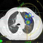 Technology Trends: Breathing easier with SBRT, VMAT, 4D MRI and other advances in lung cancer treatment