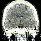 Strategies to mitigate the effects of whole-brain radiation therapy on neurocognitive function in patients with brain metastases