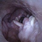 Nasopharyngeal stenosis following curative chemoradiation therapy for oropharyngeal cancer in a patient with active oral lichen 