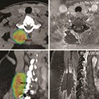 Teaching Case: Radiation Myonecrosis Following Stereotactic Body Radiation Therapy in Metastatic Renal Cell Carcinoma