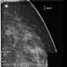 Breast MRI and its impact on partial breast irradiation