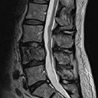 Stereotactic body radiotherapy for the treatment of spine metastasis