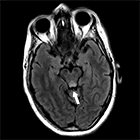 Wernicke’s Encephalopathy Secondary to Severe Malnutrition After Definitive Chemoradiation for Oropharyngeal Squamous Cell Carci