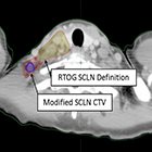 Are the current RTOG Contouring Atlas definitions for supraclavicular lymph nodes adequate for all breast cancer patients?