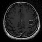 Adjuvant radiosurgery for a resected brain metastasis: A case report and literature review