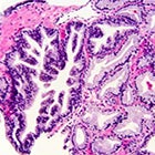 Concurrent management of low-risk prostate cancer and localized small lymphocytic lymphoma