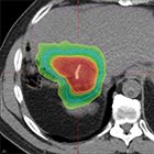 Substituting stereotactic body radiation therapy boost for brachytherapy in Mayo protocol for peri-hilar cholangiocarcinoma