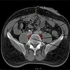 Lumbosacral plexus: An unattended organ at risk in irradiation of pelvic malignancies