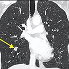 An abscopal effect in a case of neuroendocrine atypical carcinoid lung cancer