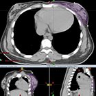 Optimizing treatment positioning to achieve better heart sparing in a left-sided, whole-breast irradiation