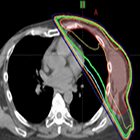 Volumetric-modulated arc therapy improved heart and lung sparing for a left-sided chest wall and regional nodal irradiation case