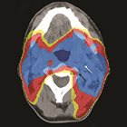 Radiation-induced Carotid and Vertebral Artery Stenosis in the Intensity-modulated Radiation Therapy Era: A Case Report