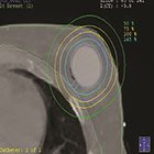 Aggressive Multimodality Therapy for Treatment of a Locally Advanced Radiation-Related Chest Wall Sarcoma