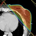 Cardiac-sparing radiation therapy for breast cancer