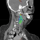 Horner’s Syndrome following salvage stereotactic ablative radiation therapy (SABR) for recurrent laryngeal carcinoma with prior 