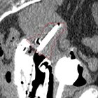 Brachytherapy for Cervical Cancer in an Asymptomatic Patient with Confirmed COVID-19 Diagnosis