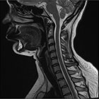 Craniospinal Irradiation for Leptomeningeal Disease in Recurrent Breast Cancer