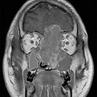 Spinal leptomeningeal metastasis of sinonasal undifferentiated carcinoma