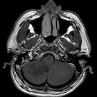 Subclinical recurrence of anaplastic astrocytoma: Demonstrating the difficulty in distinguishing progression from pseudoprogress