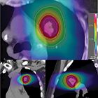 Radiation Oncology Case: Radiographic changes of the lung after stereotactic body radiation therapy