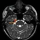 The trigeminocardiac reflex during linac- based hypofractionated stereotactic radiation therapy for a skull base tumor