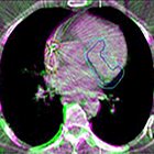 Noninvasive Cardiac Radioablation at Washington University: Past, Present, Future Directions for the Treatment of VT