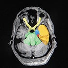 Linac-based stereotactic radiosurgery for trigeminal neuralgia