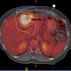 Stereotactic body radiation therapy (SBRT) for early-stage primary liver cancer (HCC)