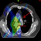 Incidental nodal irradiation in locally advanced non-small cell lung cancer treated with involved-field IMRT