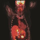 Locoregional Chemoradiation for a Patient with BRCA1 Stage IV Pancreatic Adenocarcinoma