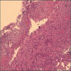 Long-term cure of stage IVB esophageal adenocarcinoma