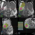 Stereotactic ablative radiation therapy in the treatment of liver tumors