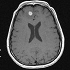 Wanted: Dead or alive? Distinguishing radiation necrosis from tumor progression after stereotactic radiosurgery