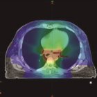 Trends, trials and developments in radiation therapy for esophageal cancer