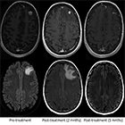 Role of Boswellia Serrata in Management of CNS Radiation Necrosis After Radiosurgery for Brain Metastases