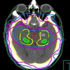 A treatment planning class solution for hipppocampal avoidance whole brain irradiation using volumetric-modulated arc radiothera