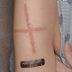 Severe contact dermatitis secondary to metal contaminants in radiation therapy paint pens