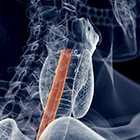 Controversies in the preoperative radiotherapeutic management of resectable esophageal cancer