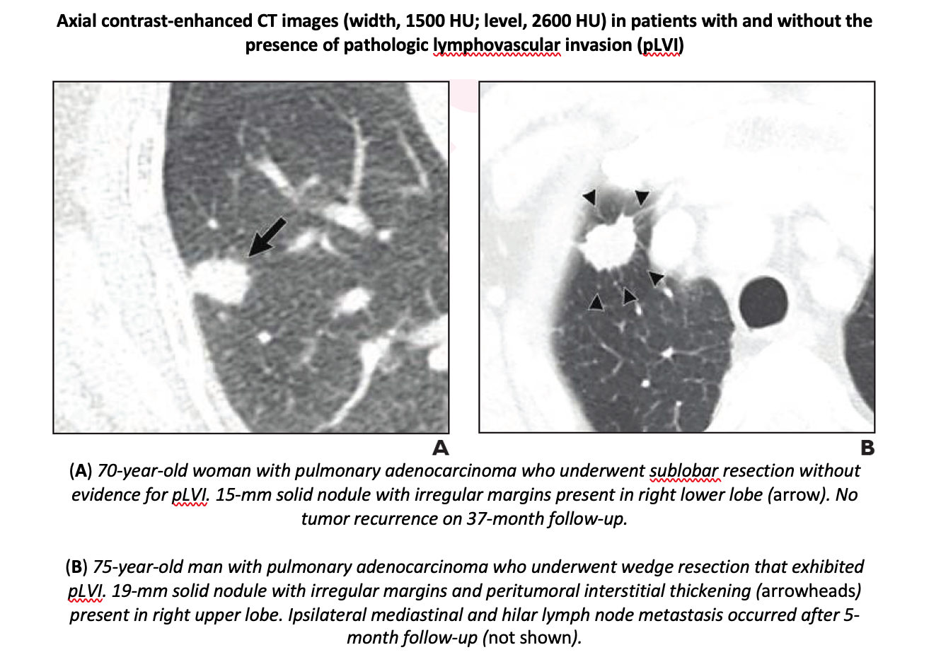 CT may Help Identify Candidates for Sublobar Resection in Early 