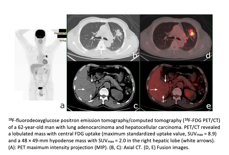FDG PET/CT Improves Diagnosis of Synchronous Multiple Primary Malignant ...