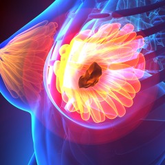 Metastatic Breast Cancer Treatments Help Reduce Deaths