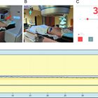 A Practical Method to Prolong Expiratory Breath Holds for Abdominal Stereotactic Body Radiation Therapy