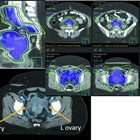 Special Considerations of Pelvic Radiation Therapy in the Adolescent and Young Adult (AYA) Female Population