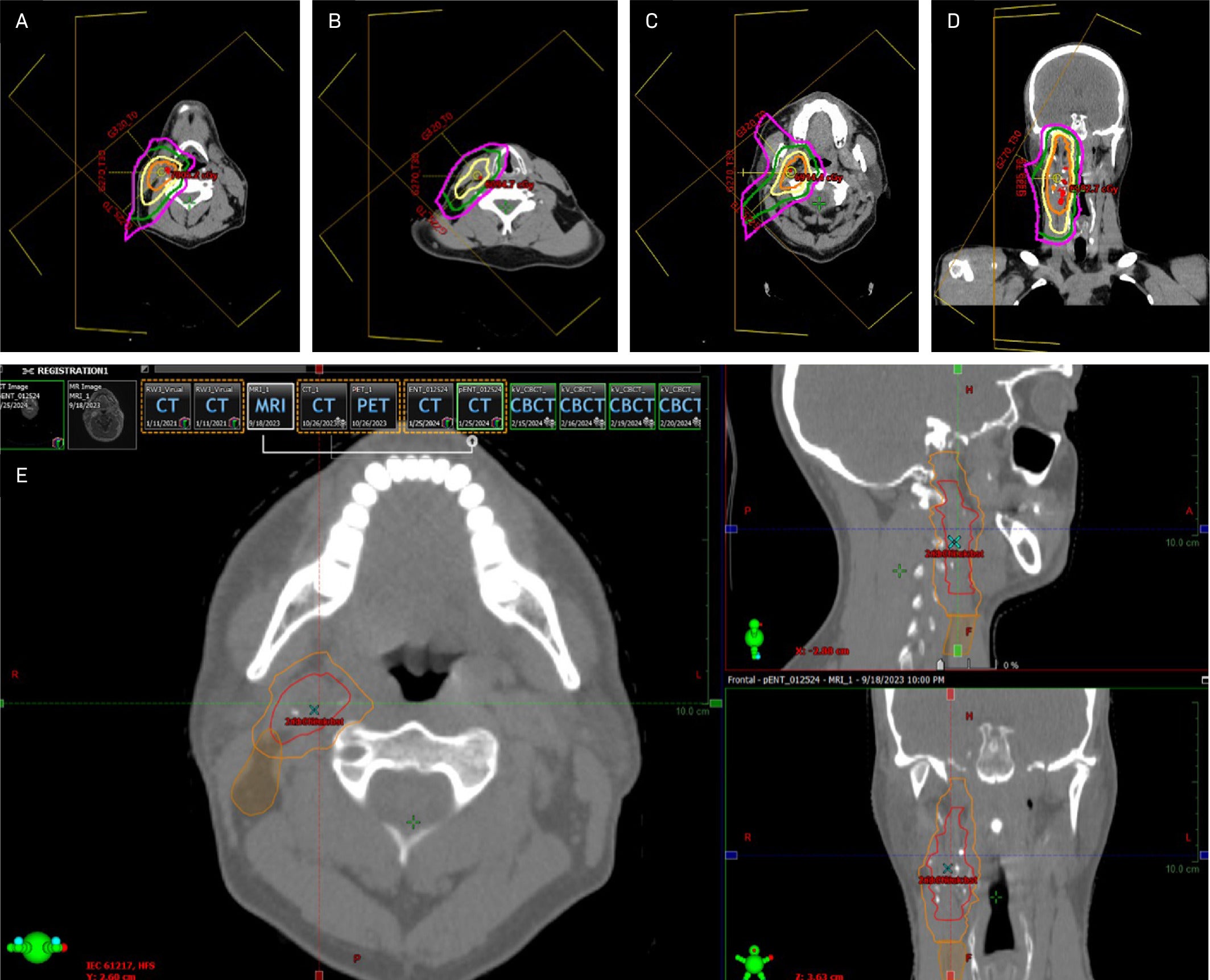 Malignant Melanotic Nerve Sheath Tumor of the Neck: A Case Report